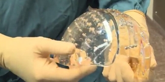 Пациентке в Голландии заменили часть черепа напечатанным на 3D принтере протезом